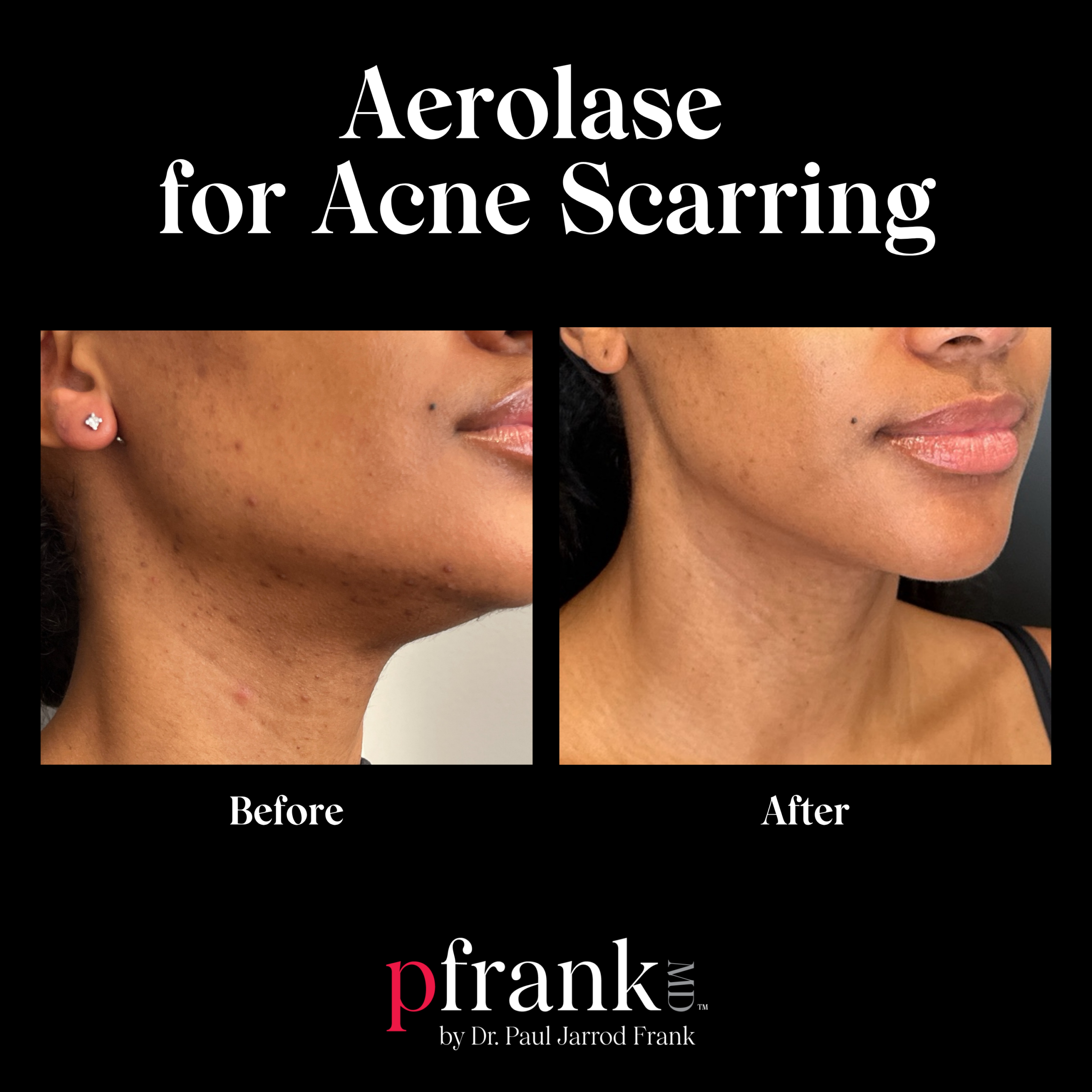Aerolase for Acne and Acne Scarring