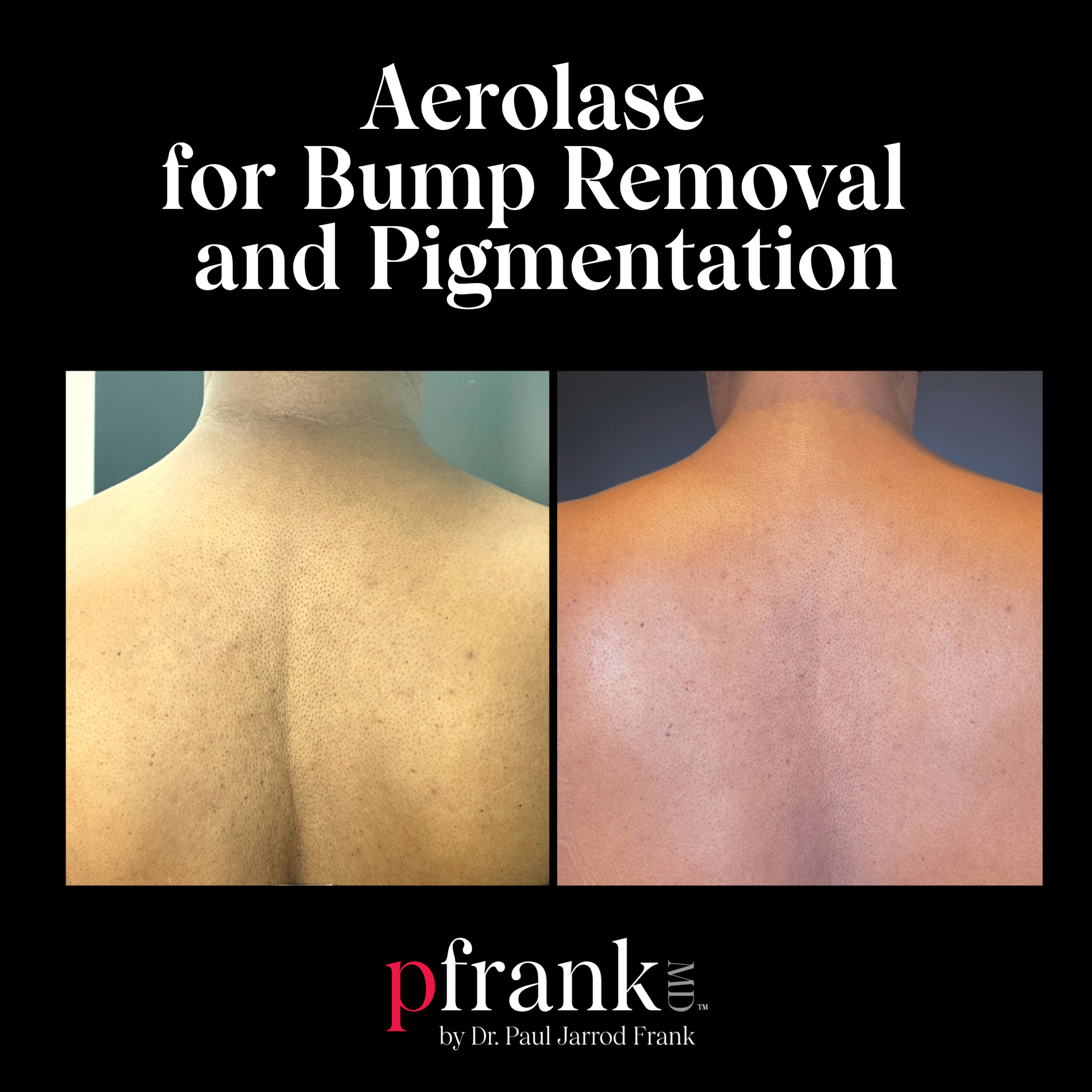 Aerolase for Bump Removal and Pigmentation