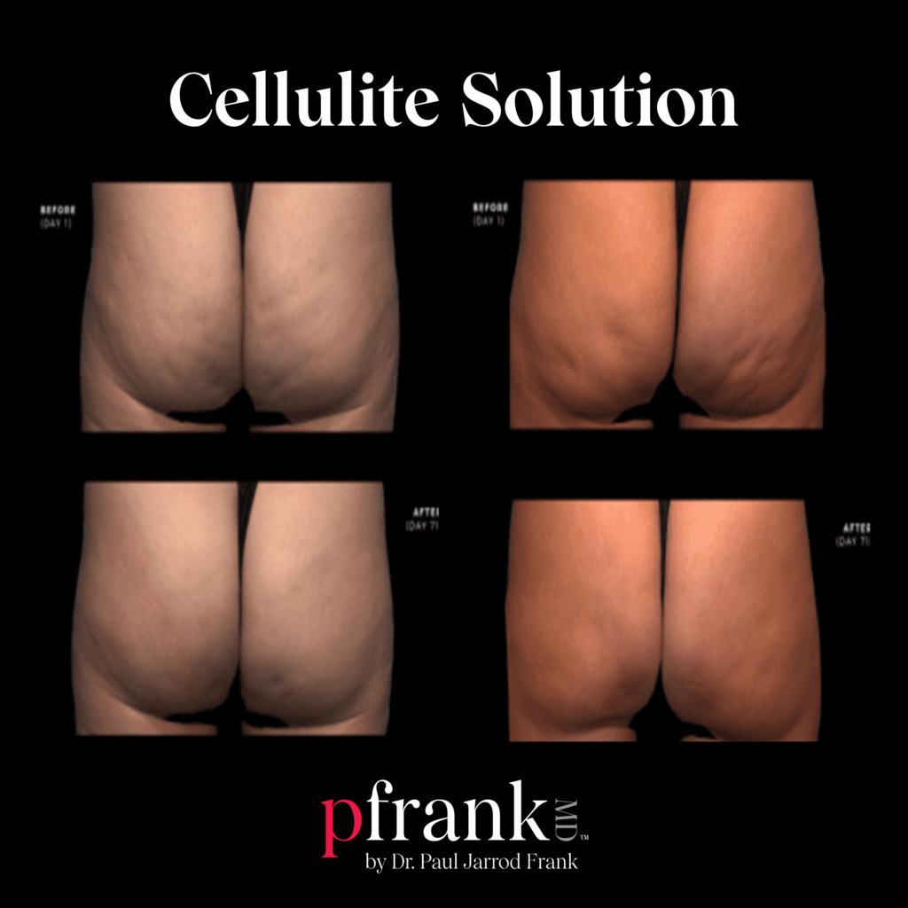 PFRANKMD Cellulite Solution