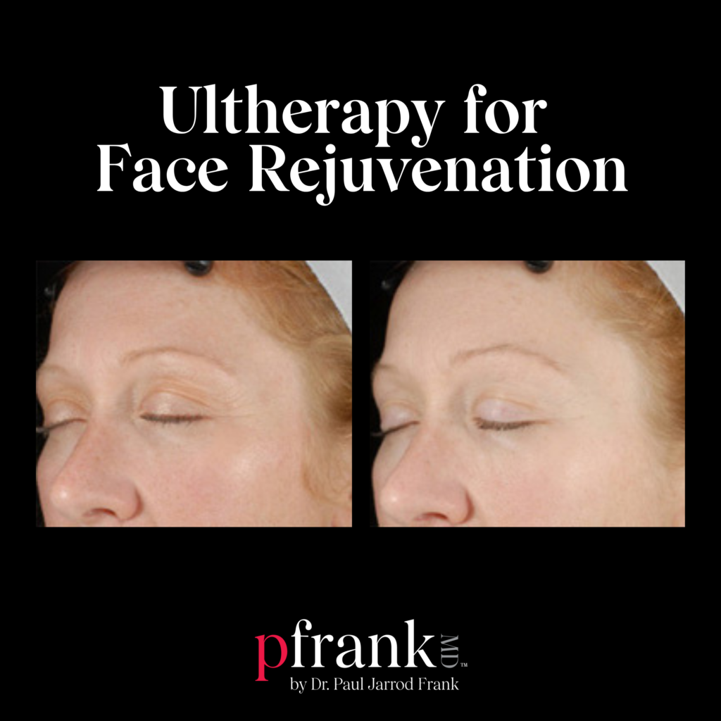 Ultherapy for Face Rejuvenation