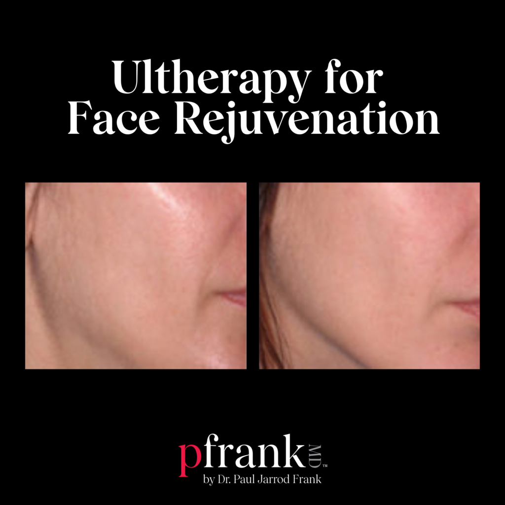 Ultherapy for Face Rejuvenation