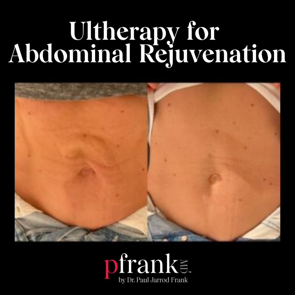 Ultherapy and Vivace Microneedling for Abdominal Rejuvenation