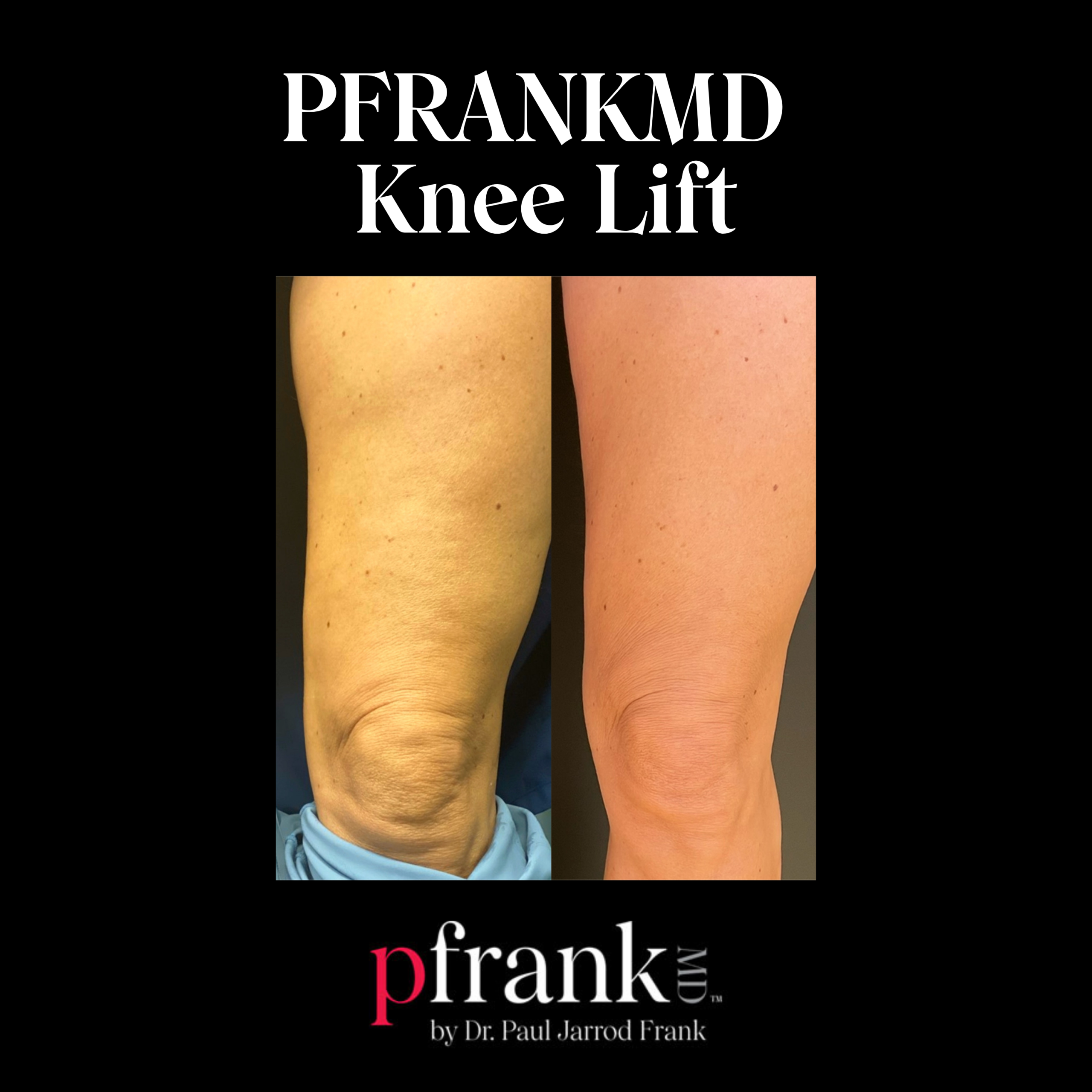 PFRANKMD Knee Lift