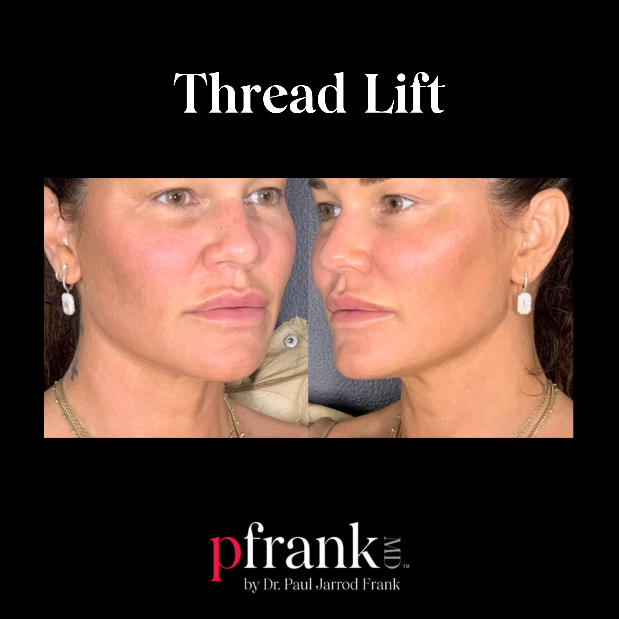 PFRANKMD Thread Lift Skin Tightening