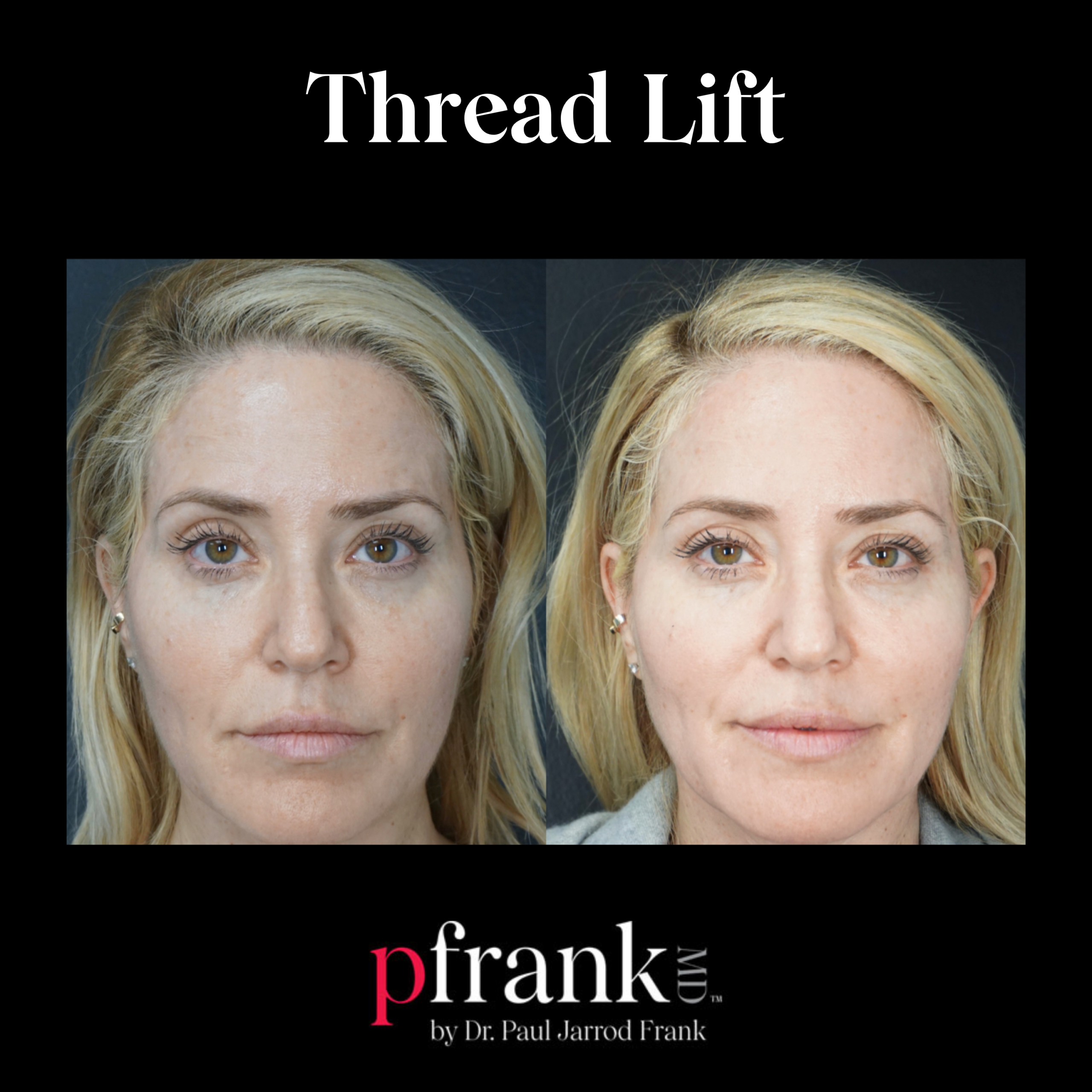 PFRANKMD Thread Lift Skin Tightening