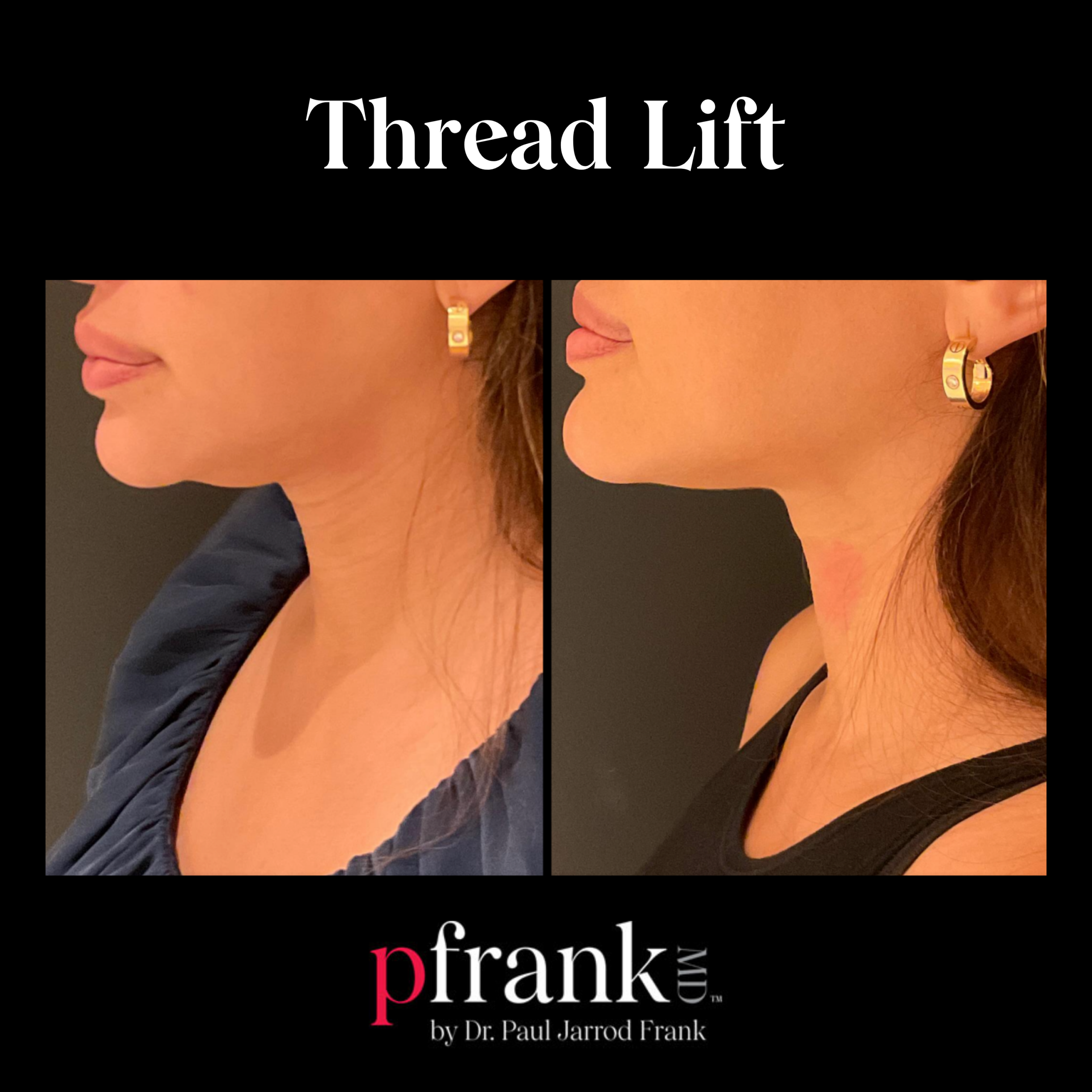 PFRANKMD Thread Lift Skin Tightening