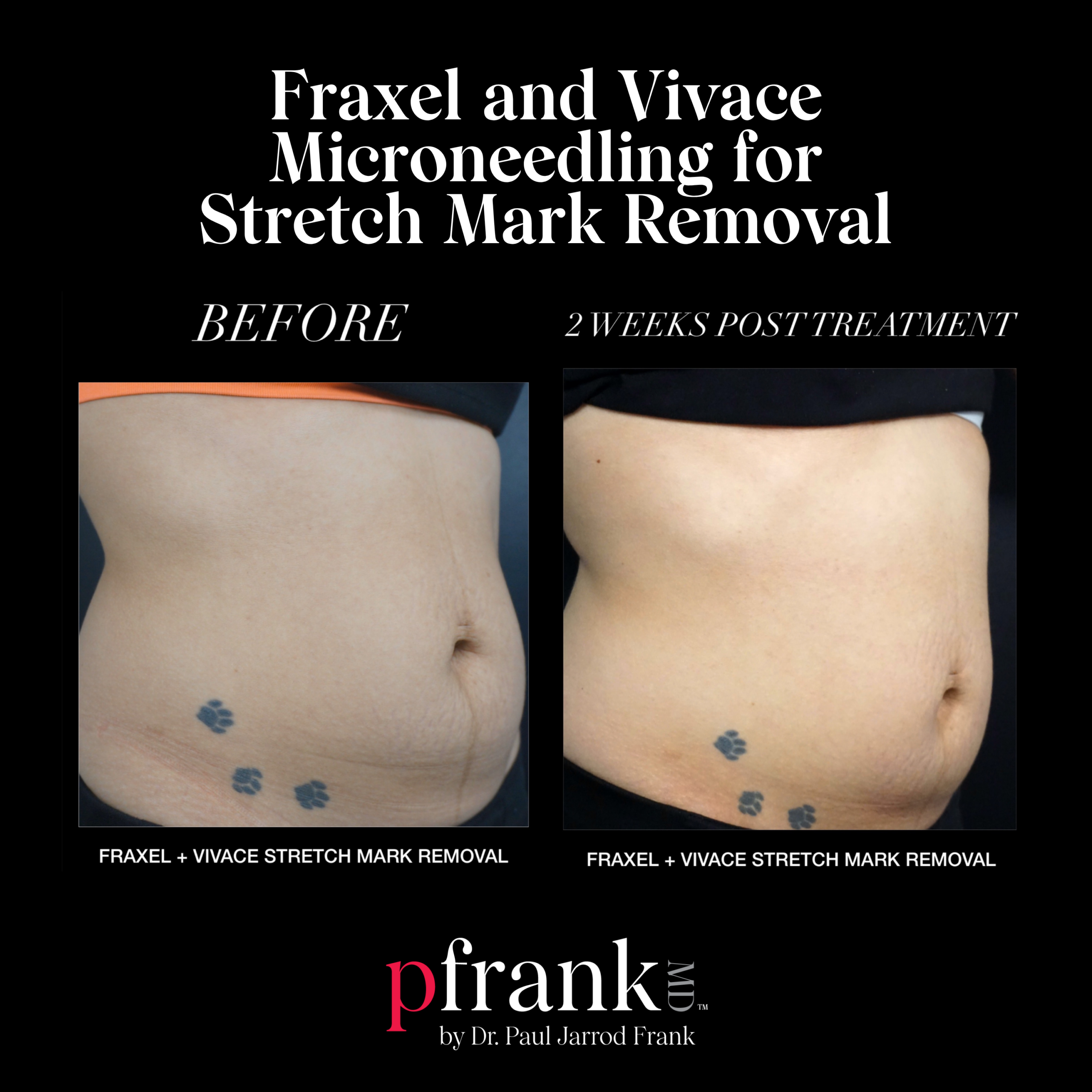 Fraxel and Vivace Microneedling for Stretch Mark Removal