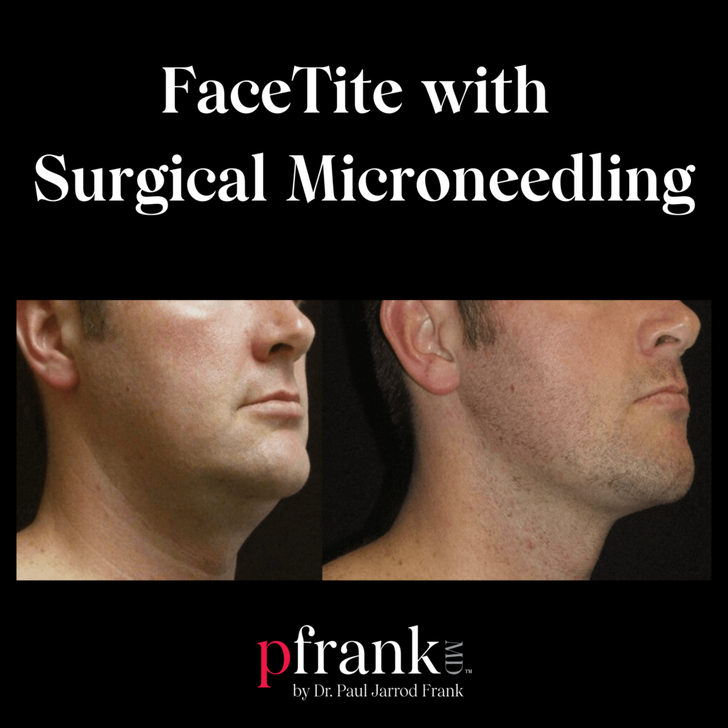 Facetite with Surgical Microneedling