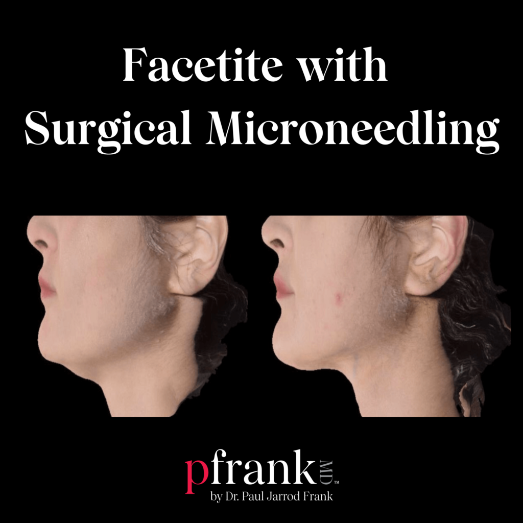 Facetite with Surgical Microneedling