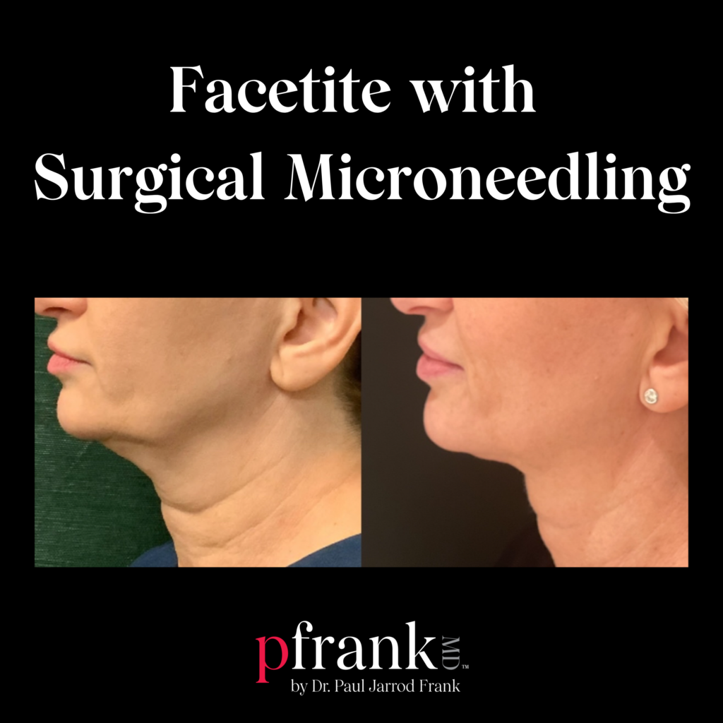 Facetite with Surgical Microneedling