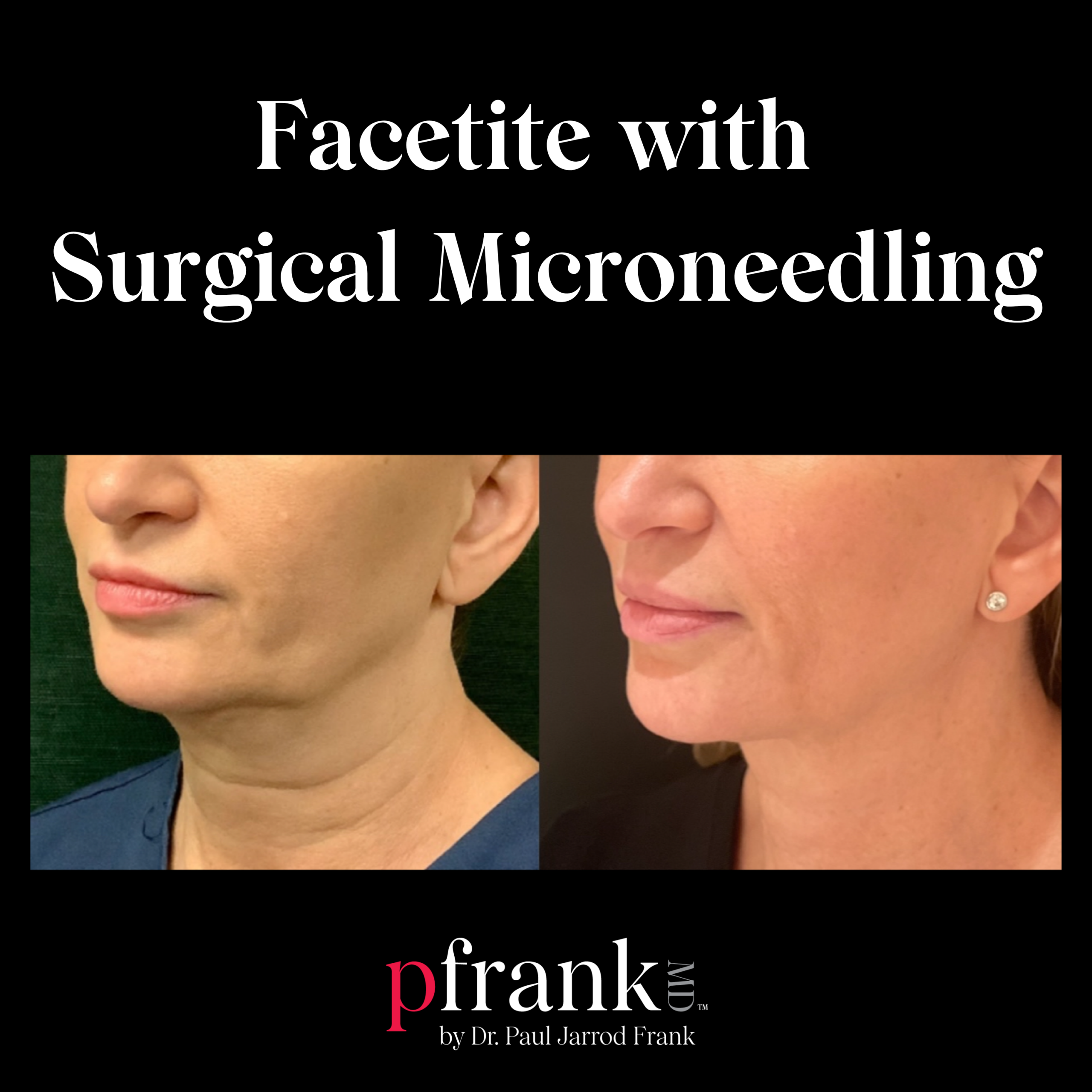 Facetite with Surgical Microneedling