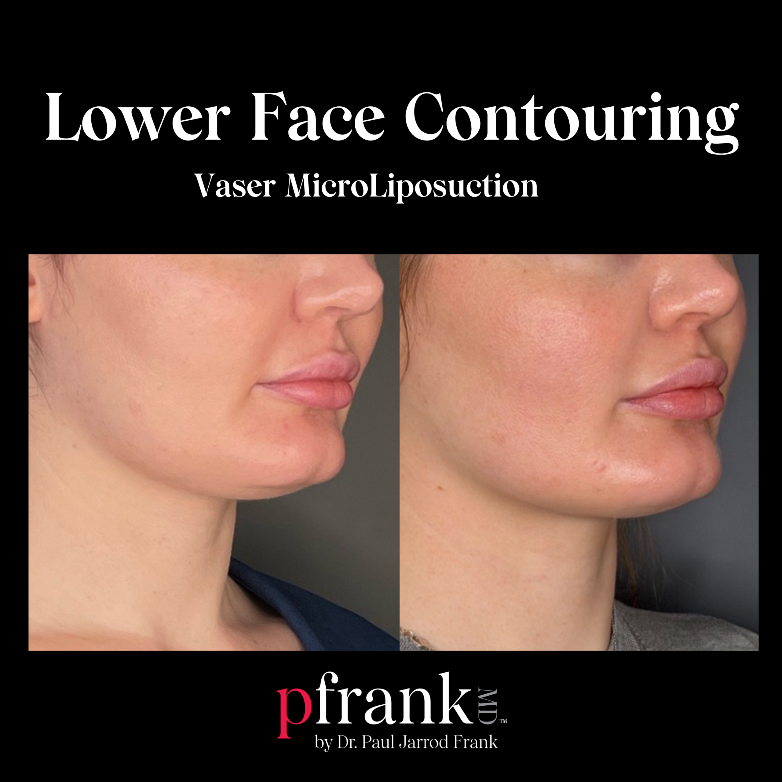 Lower Face Contouring with Vaser MicroLipo