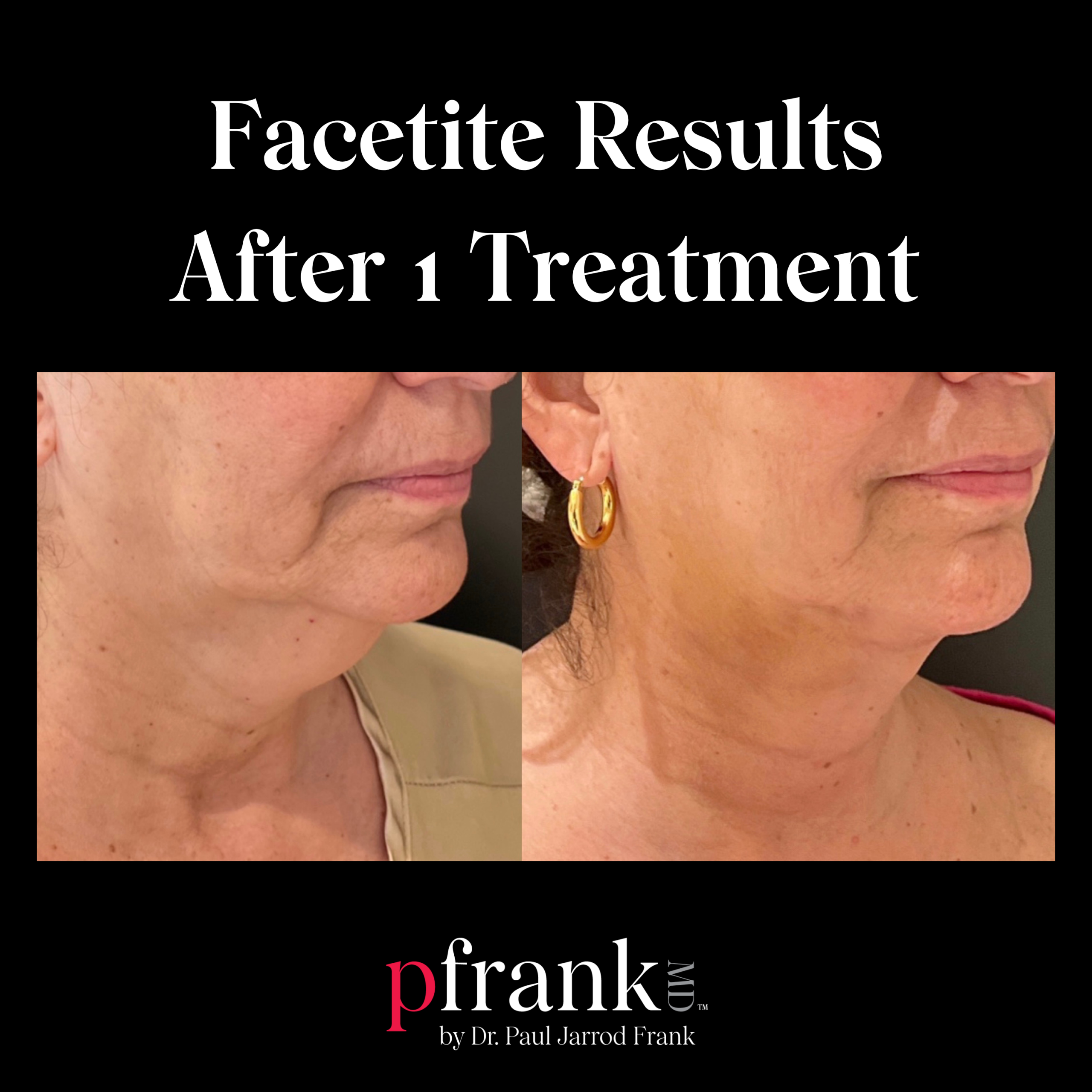 Facetite Results after 1 Week