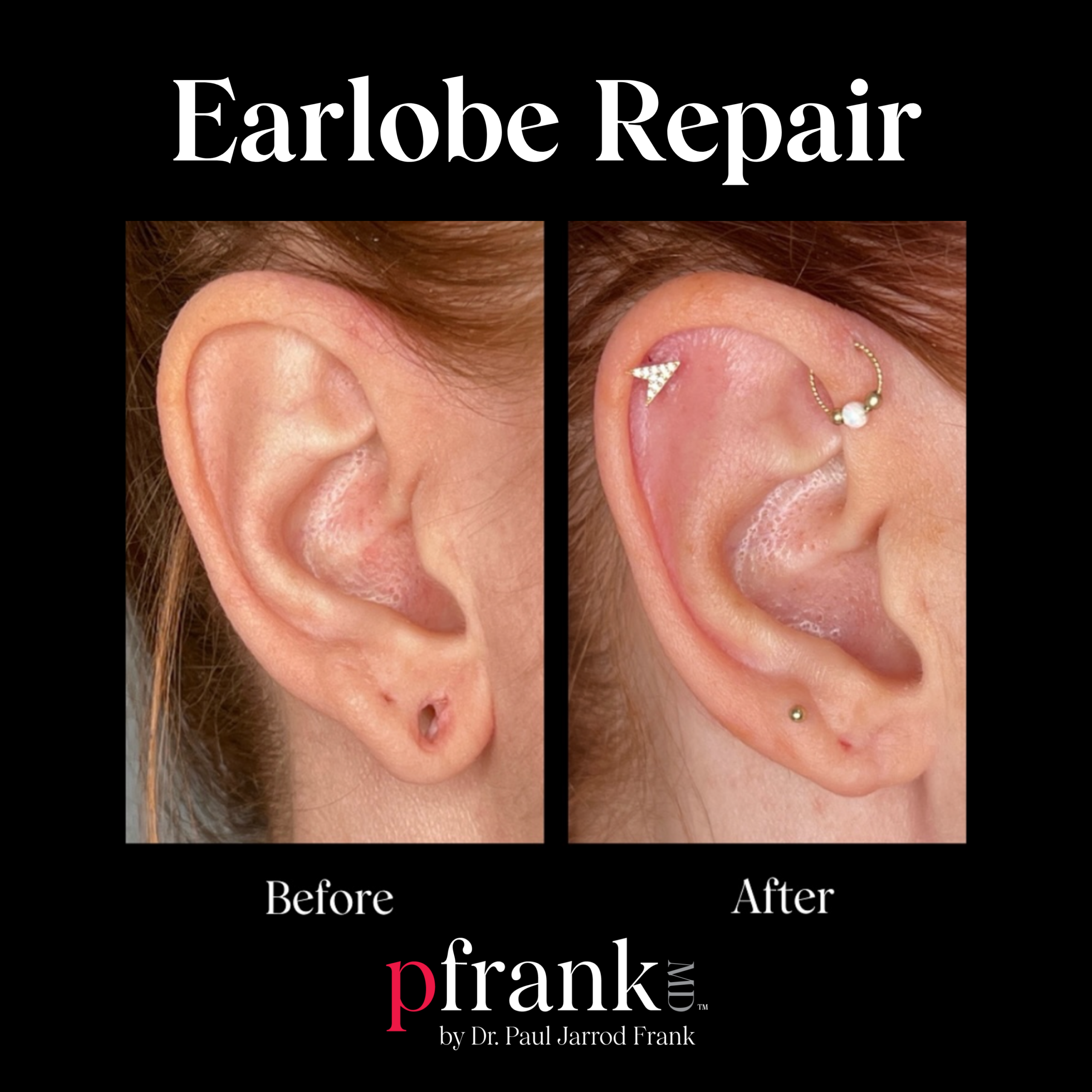 Earlobe Repair and Rejuvenation