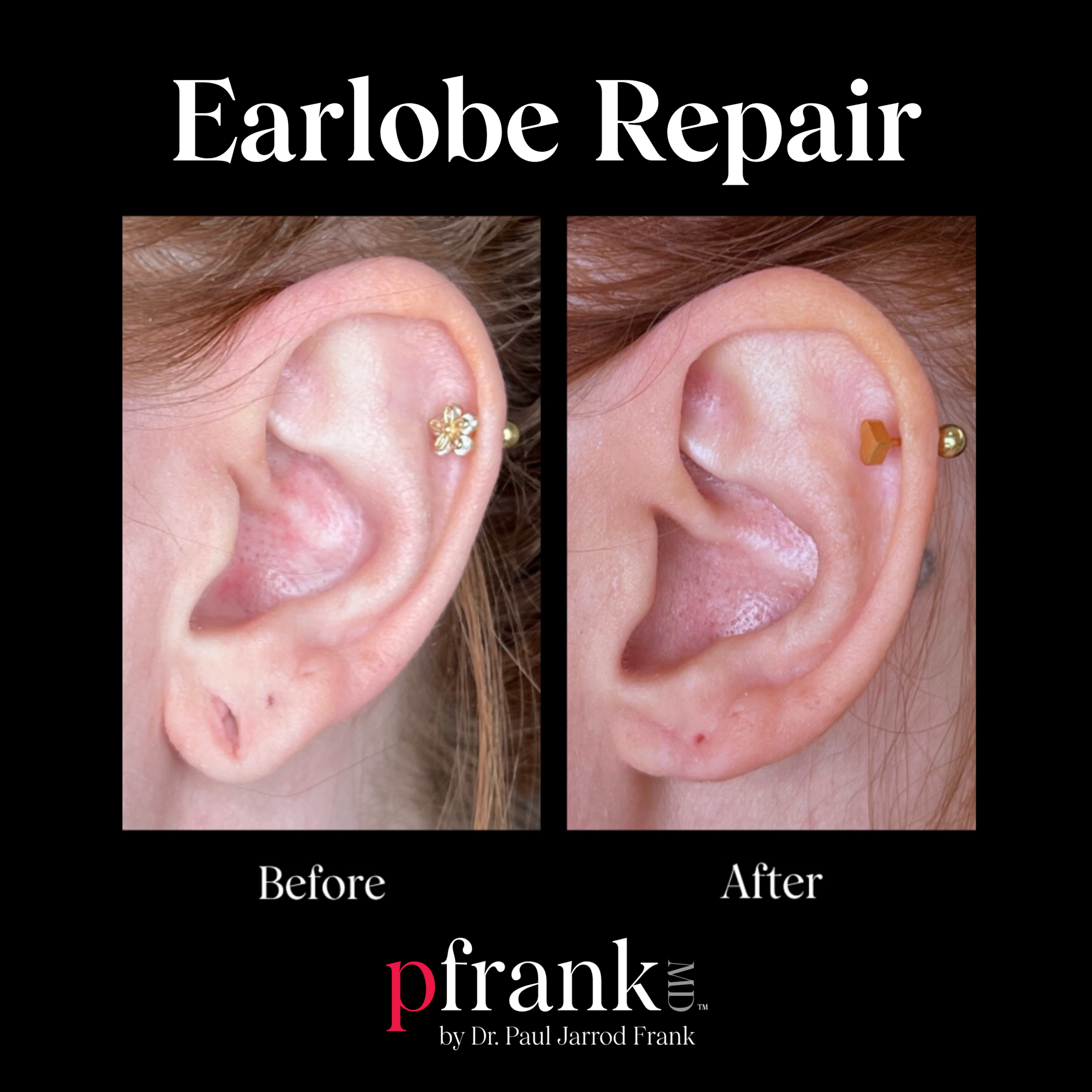 Earlobe Repair and Rejuvenation