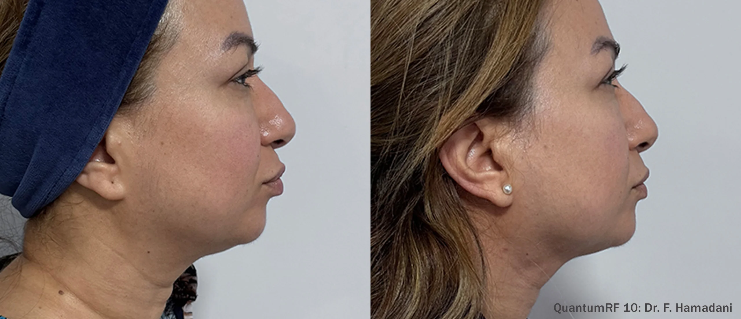 Before and after: Face, right side. QuantumRF 10, Dr. F. Hamadani.