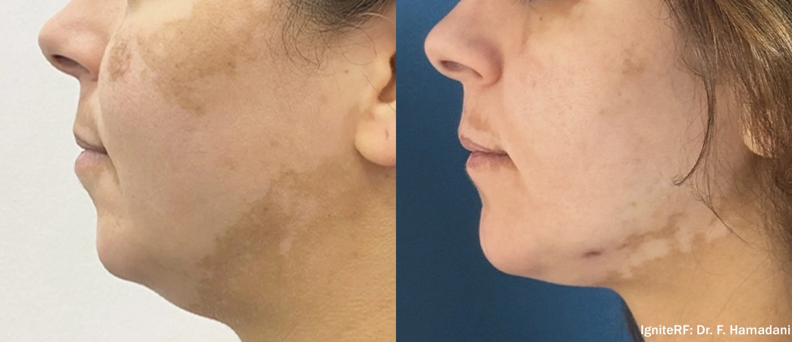 Before and after: Jowl and jawline, side view. IgniteRF, Dr. F. Hamadani.