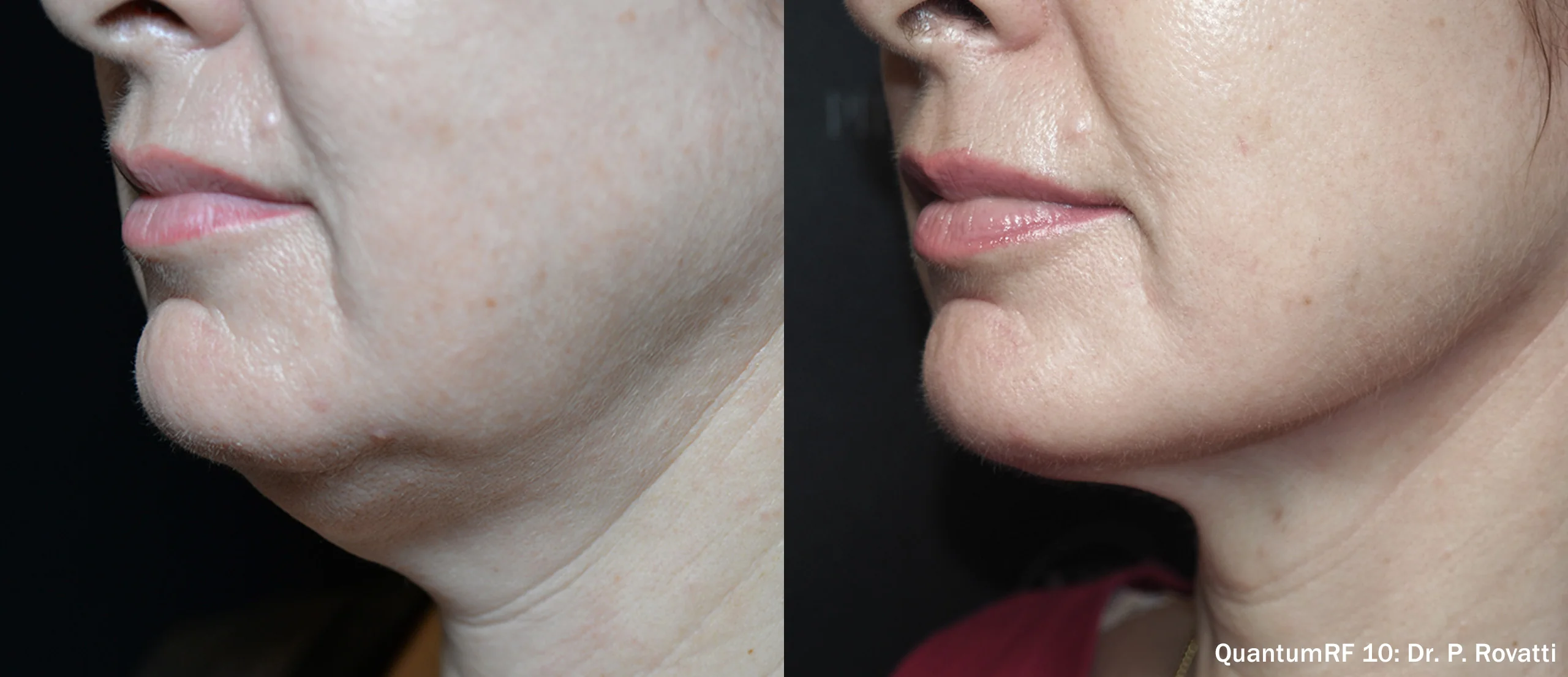 Before and after: Jowl and jawline, side view. QuantumRF 10, Dr. P. Rovatti.
